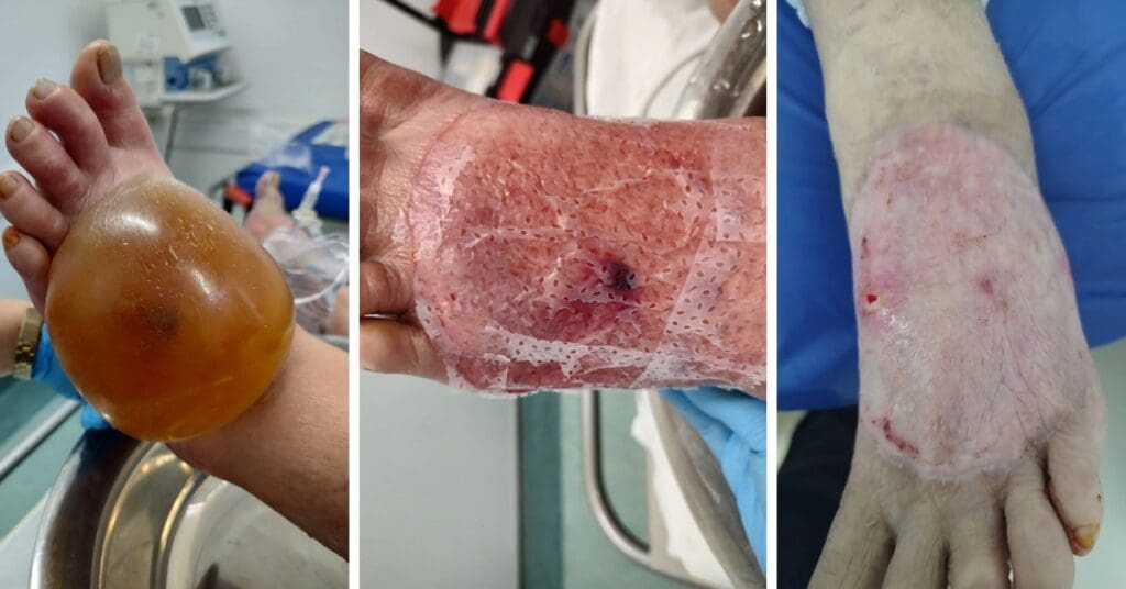 Ferida por picada de inseto: como tratar corretamente