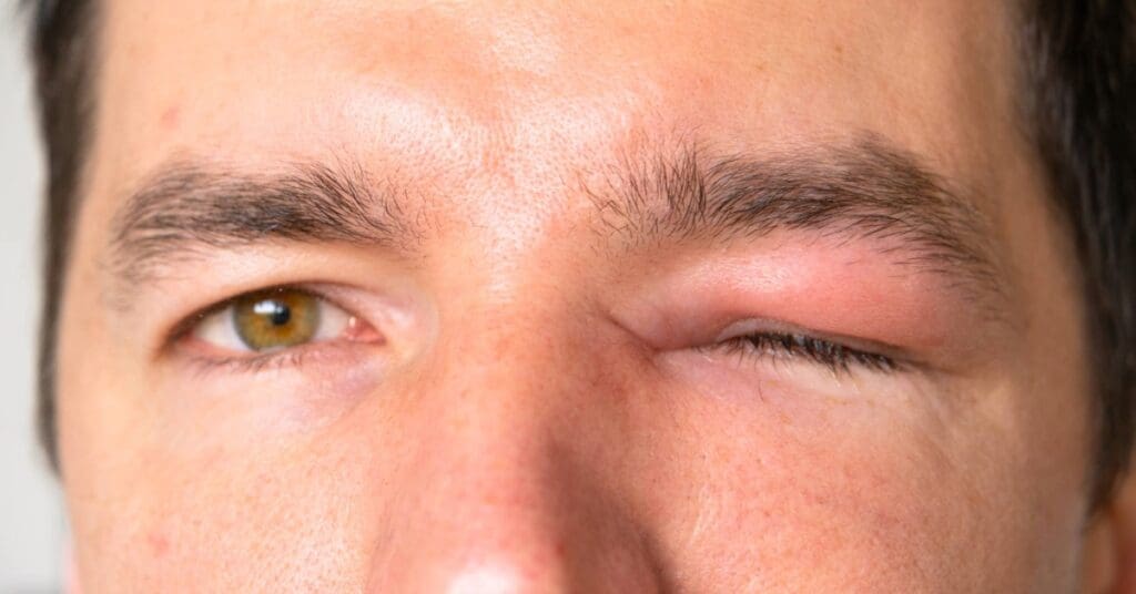 Ferida por picada de inseto: como tratar corretamente