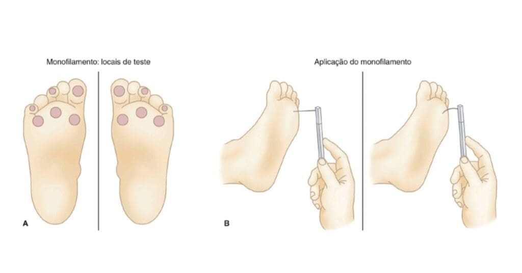 Úlcera Neuropática: Causas, Tratamento e Cuidados Essenciais