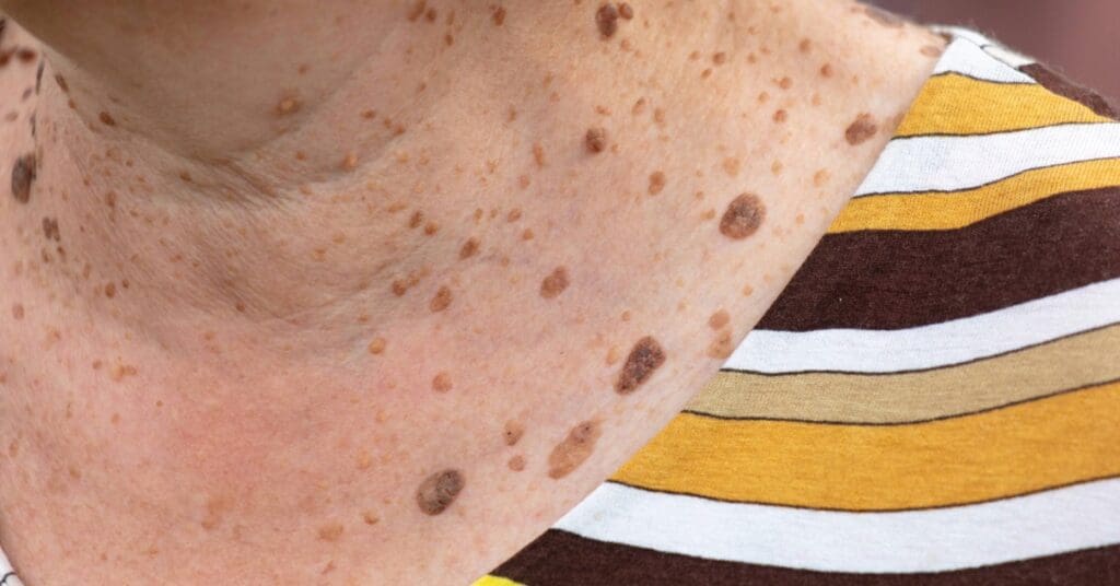 Úlcera de Marjolin: entenda a transformação de feridas crônicas