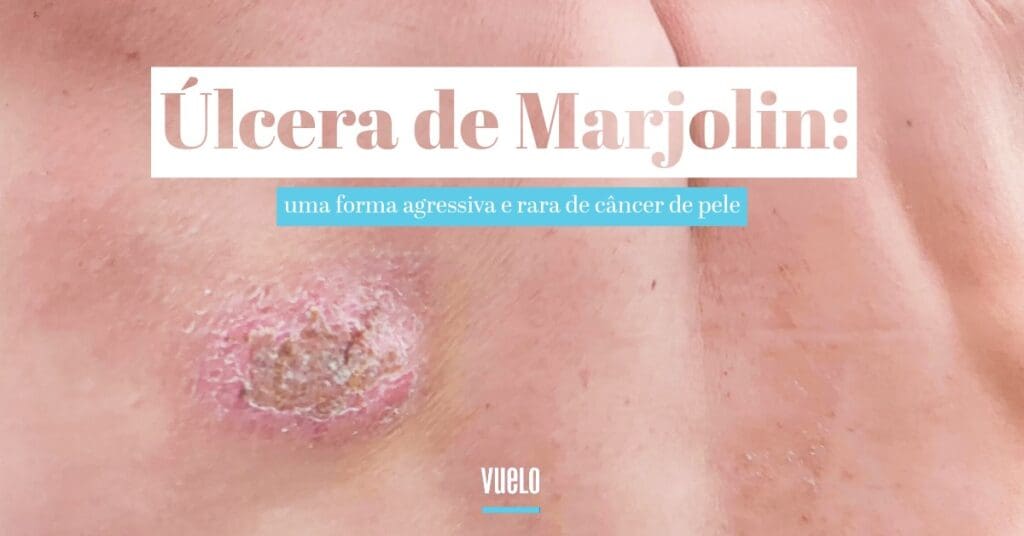 Úlcera de Marjolin: entenda a transformação de feridas crônicas