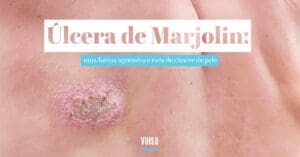 Úlcera de Marjolin: entenda a transformação de feridas crônicas