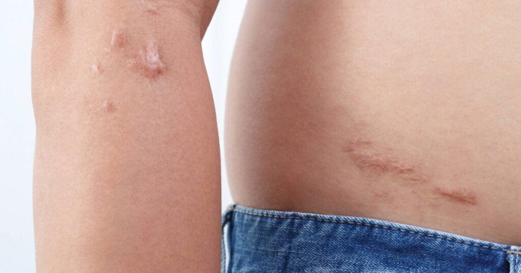 Úlcera de Marjolin: entenda a transformação de feridas crônicas