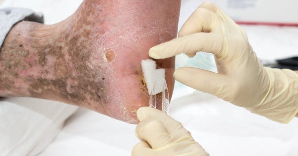 Úlcera de Marjolin: entenda a transformação de feridas crônicas