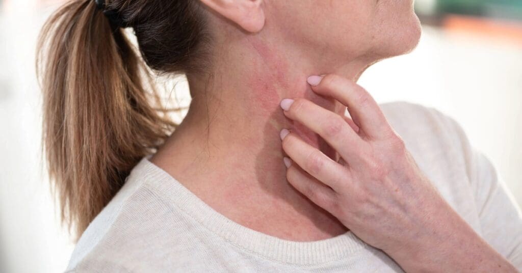 Urticária colinérgica: o que é, sintomas, causas e tratamentos