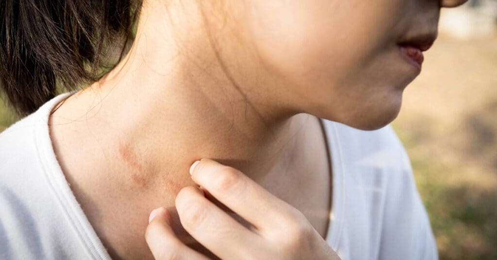 Urticária colinérgica: o que é, sintomas, causas e tratamentos