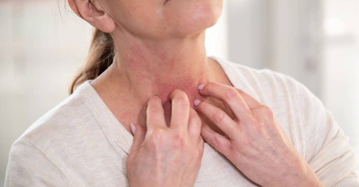 Urticária colinérgica: o que é, sintomas, causas e tratamentos