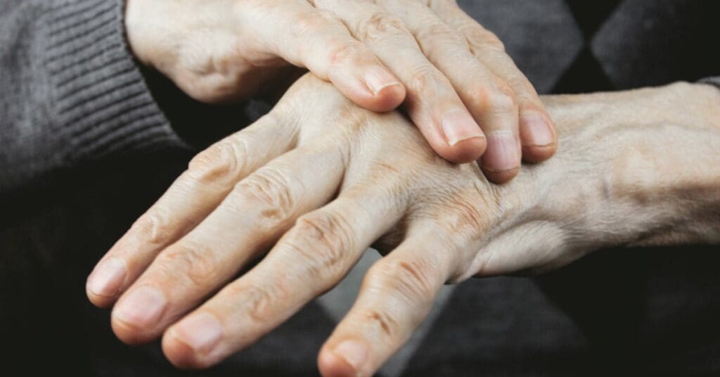 O que é vasculite cutânea? Conheça os sinais e como tratar