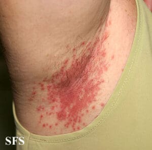 Candidíase na pele: saiba identificar, tratar com calma e evitar voltar